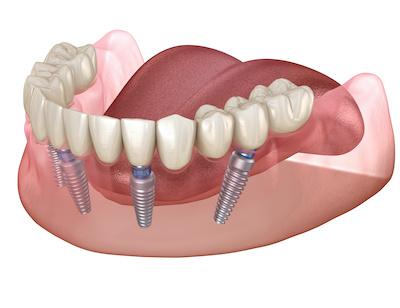 all-on-4 dental implants in ocala fl