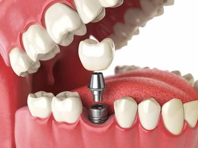 image of a dental implant at sutton dentistry in ocala fl
