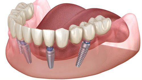 3D diagram showing All-on-4 implants anchoring a full arch of replacement teeth in the jaw