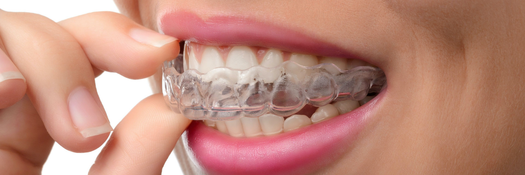 Wearing clear aligner in Ocala, FL
