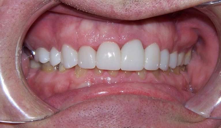 After smile with brighter teeth and improved shape following cosmetic dentistry in Ocala, FL
