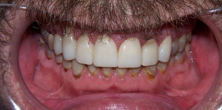 Close-up of teeth showing wear and alignment issues before cosmetic dentistry in Ocala, FL