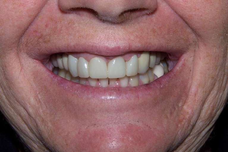 After smile with improved shape and color following cosmetic dental treatment in Ocala, FL