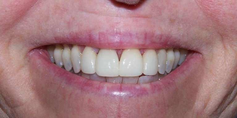 Chipped and uneven teeth restored with natural looking cosmetic dentistry in Ocala, FL
