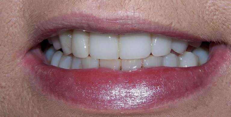 Smile transformation with dental veneers and bonding in Ocala, FL