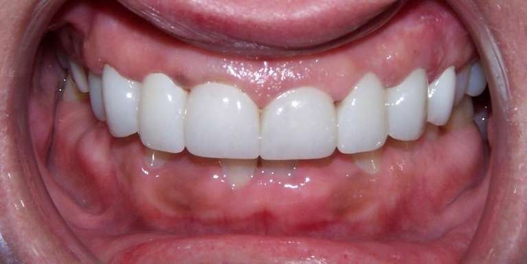 Discolored and uneven teeth corrected with a natural looking smile makeover in Ocala, FL