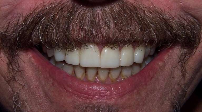 Close-up of smile showing smoother edges and a more balanced appearance after cosmetic care in Ocala, FL
