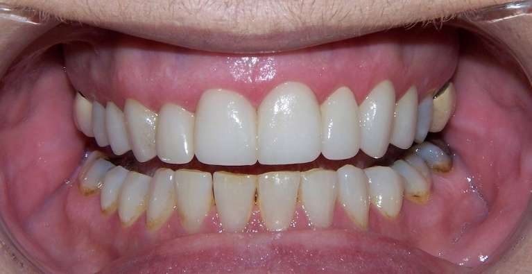 Smile restored with crowns and cosmetic dentistry in Ocala, FL