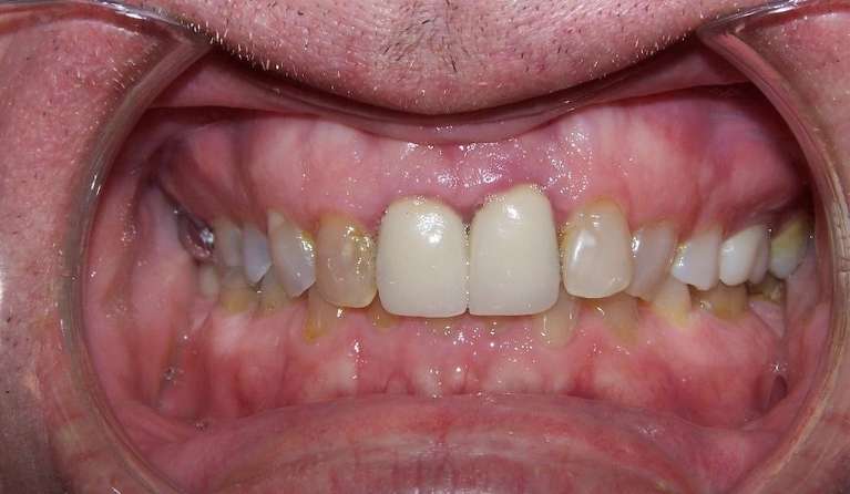 Close-up of teeth showing discoloration and irregular edges before dental work in Ocala, FL