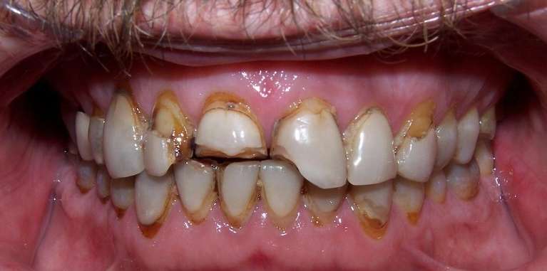 Before smile with uneven spacing and discoloration prior to treatment in Ocala, FL