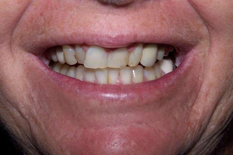 Before smile with uneven and discolored teeth prior to cosmetic treatment in Ocala, FL