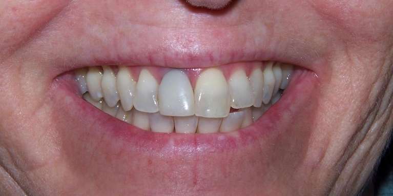 Before and after smile makeover with veneers and cosmetic bonding in Ocala, FL