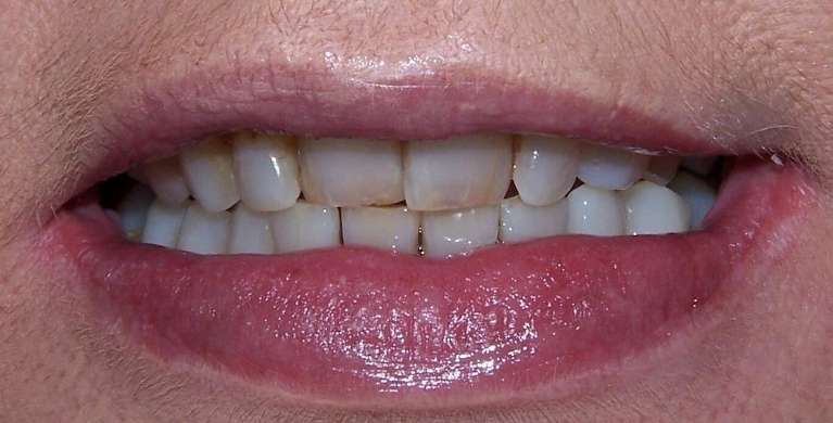 Before and after smile makeover using cosmetic dentistry in Ocala, FL