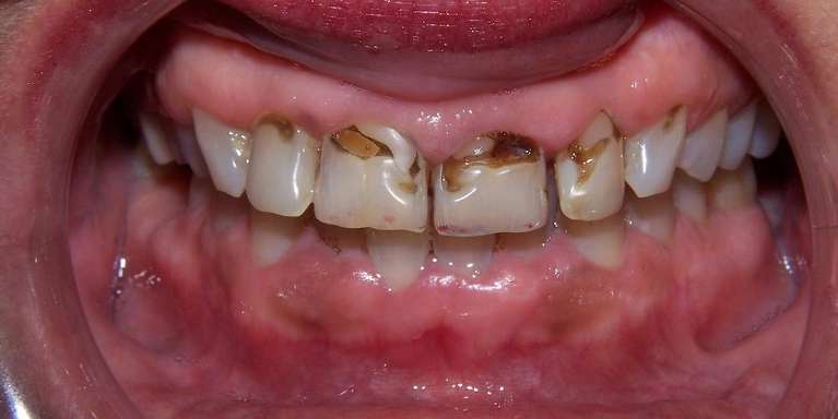 Before and after cosmetic treatment improving tooth shape and alignment in Ocala, FL