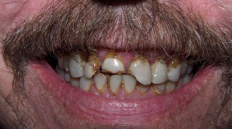 After smile with improved color and more even tooth shape following treatment in Ocala, FL