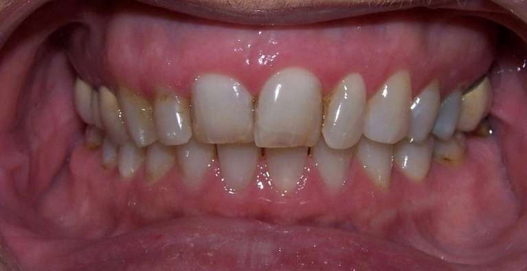 Before and after results of cosmetic dental treatment improving shape and color in Ocala, FL