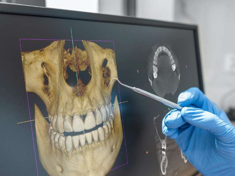 3D CBCT scan of jaw and teeth displayed on monitor for advanced diagnostics and implant planning at Sutton Dentistry in Ocala, FL.
