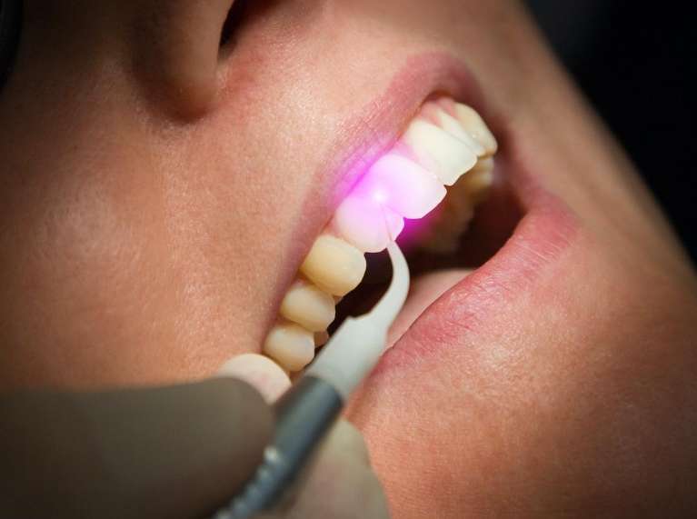 Close-up of professional dental treatment using advanced technology during a restorative procedure at Sutton Dentistry in Ocala, FL.