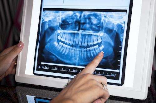 Panoramic dental X-ray showing full mouth imaging used for diagnosis and treatment planning at Sutton Dentistry in Ocala, FL.